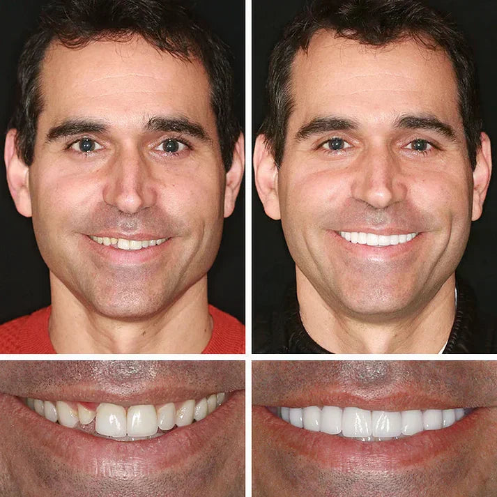 ⏰Final 3 Hours : 50%OFF🏆2026 Bestselling Product🦷 Fit for a Fresh Smile, Say Goodbye to Wearing Discomfort!🌎