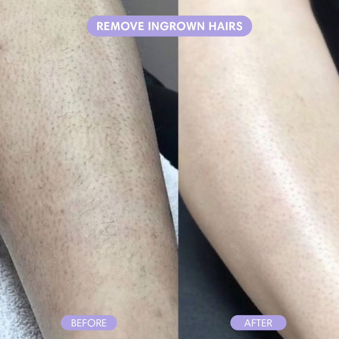 Before and after leg hair removal comparison
