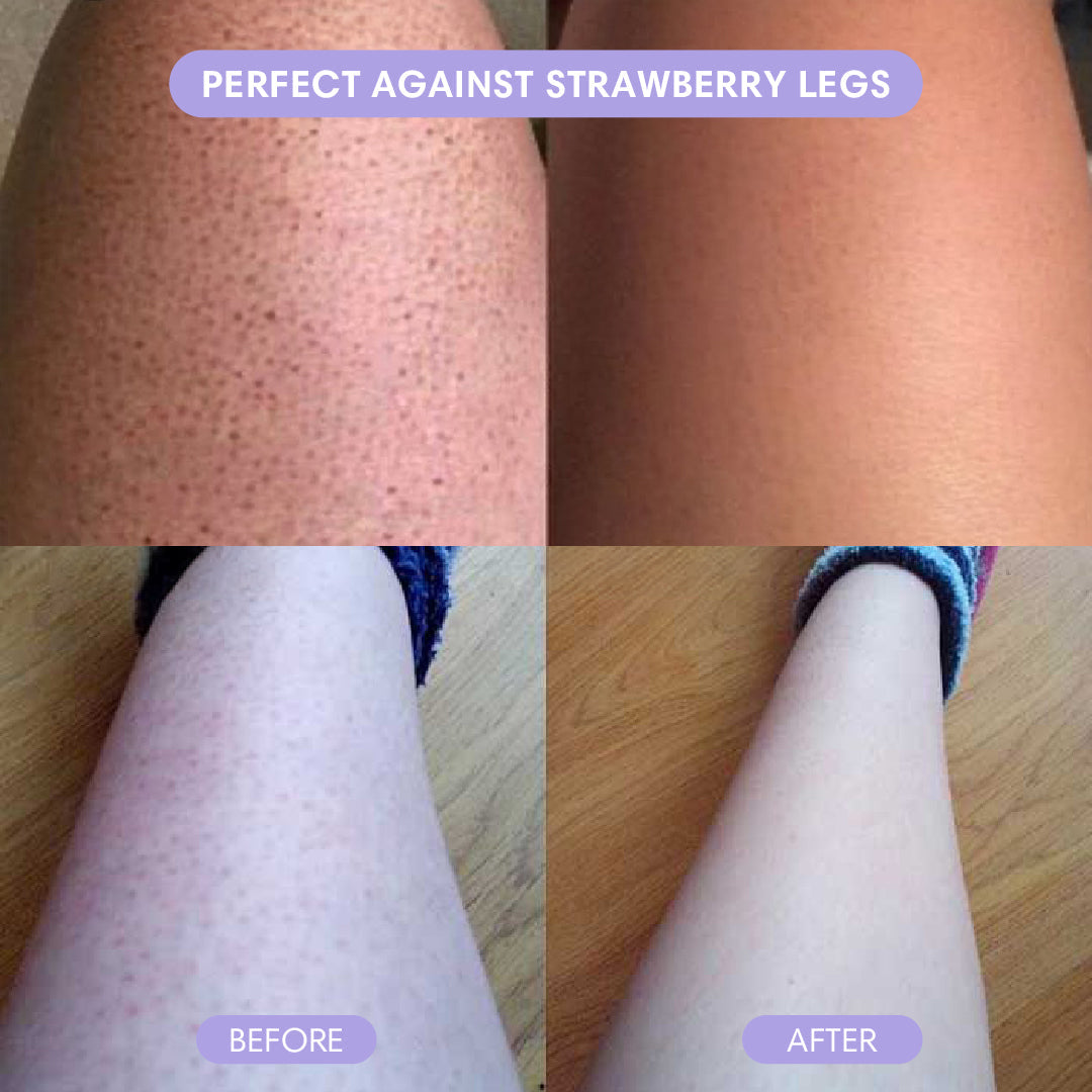 Before and after strawberry legs comparison