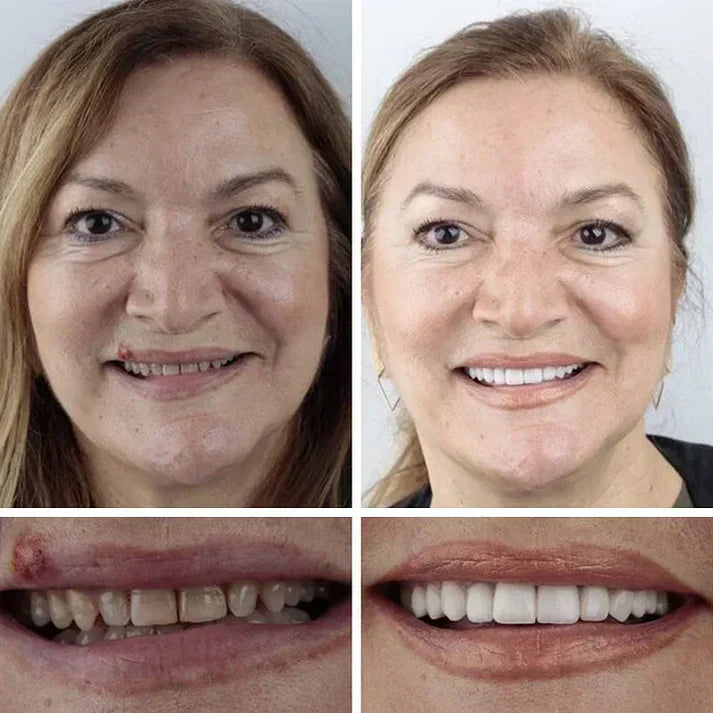⏰Final 3 Hours : 50%OFF🏆2026 Bestselling Product🦷 Fit for a Fresh Smile, Say Goodbye to Wearing Discomfort!🌎