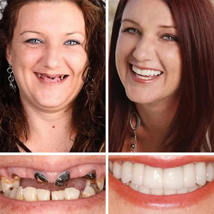 ⏰Final 3 Hours : 50%OFF🏆2026 Bestselling Product🦷 Fit for a Fresh Smile, Say Goodbye to Wearing Discomfort!🌎
